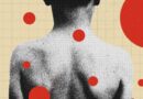The Backward Logic of Chickenpox Parties