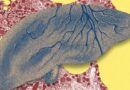 There’s a Fatty Liver Epidemic. AI Could Help Get Ahead of It