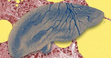 There’s a Fatty Liver Epidemic. AI Could Help Get Ahead of It